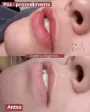 Micropigmentação labial em figueira da foz - Antes e depois