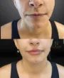 Antes depois