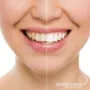 Branqueamento Dentario